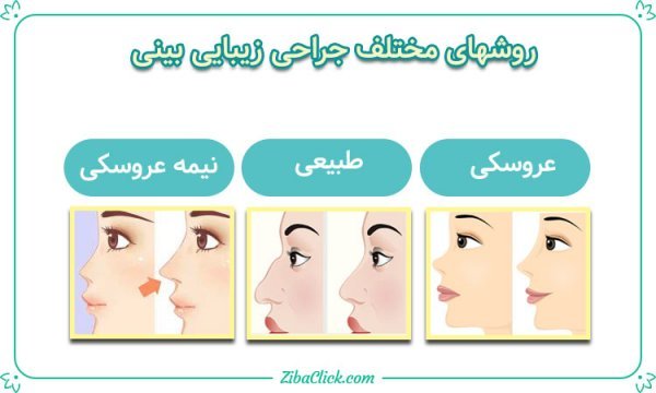  قیمت عمل / جراحی بینی در تهران ۱۴۰۴