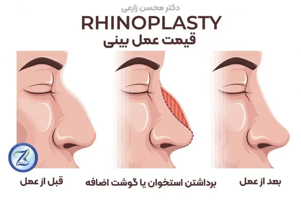  قیمت عمل / جراحی بینی در تهران ۱۴۰۴