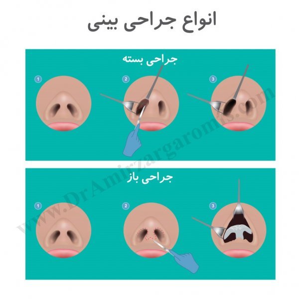  قیمت عمل / جراحی بینی در تهران ۱۴۰۴
