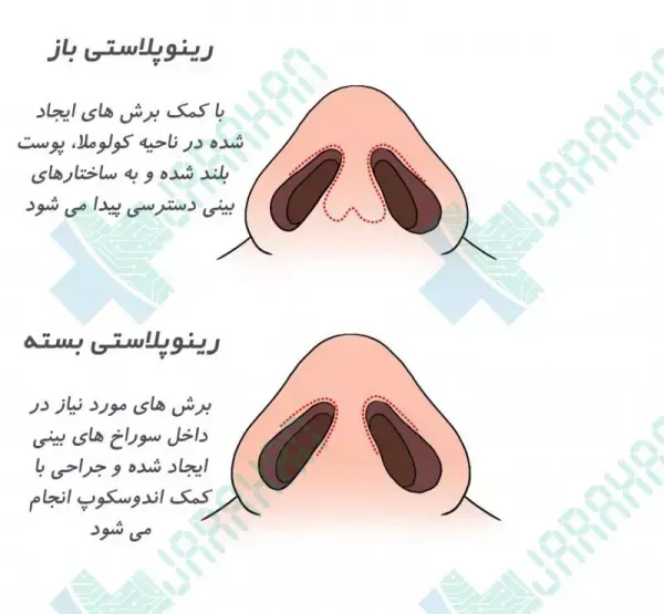  قیمت عمل / جراحی بینی در تهران ۱۴۰۴