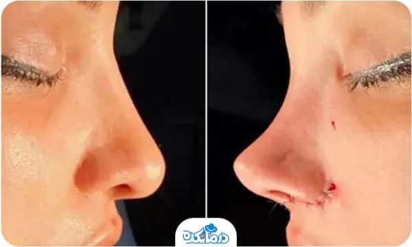  قیمت عمل / جراحی بینی در تهران ۱۴۰۴
