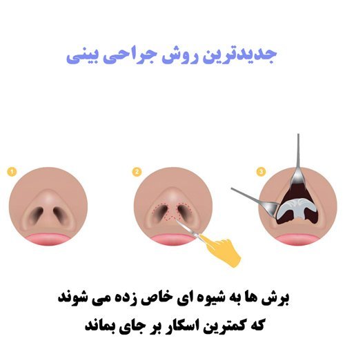  قیمت عمل / جراحی بینی در تهران ۱۴۰۴