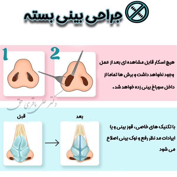  بهترین نوع عمل بینی کدام است؟