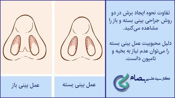  بهترین نوع عمل بینی کدام است؟