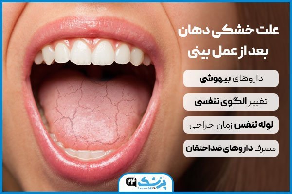  چقدر بعد از عمل بینی میتوان سکس رابطه جنسی نزدیکی داشت؟