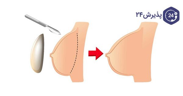 عکس و فیلم قبل و بعد پروتز سینه