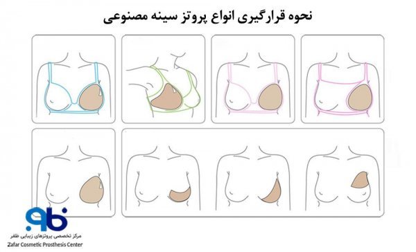  عکس و فیلم قبل و بعد پروتز سینه