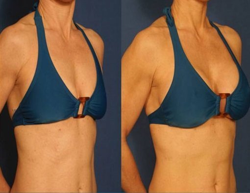 پروتز سينه اقساطي در تهران