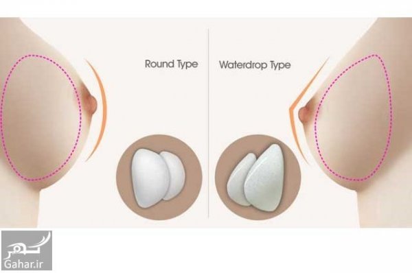  پروتز سينه اقساطي در تهران