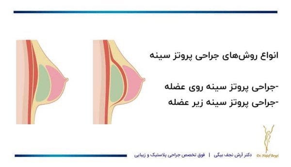 فیلم عمل پروتز سينه زیر عضله+پروتز سینه سایز ۸۵
