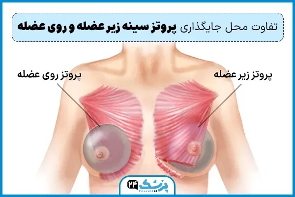  فیلم عمل پروتز سينه زیر عضله+پروتز سینه سایز ۸۵