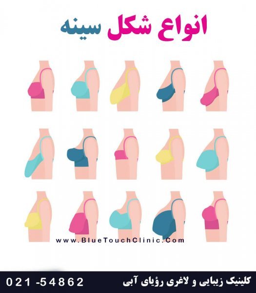  فیلم عمل پروتز سينه زیر عضله+پروتز سینه سایز ۸۵