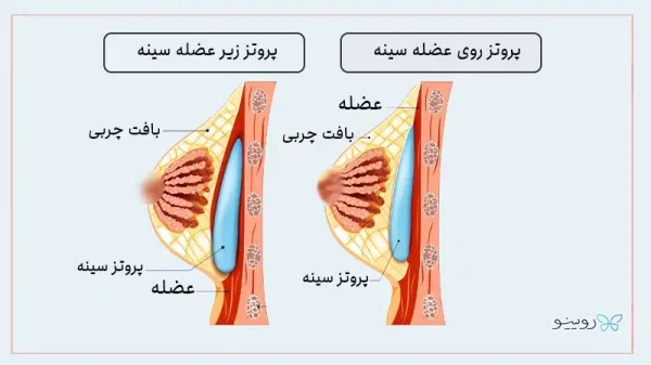  فیلم عمل پروتز سينه زیر عضله+پروتز سینه سایز ۸۵