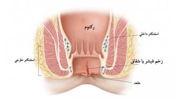  آیا رابطه مقعدی باعث زگیل تناسلی میشود؟