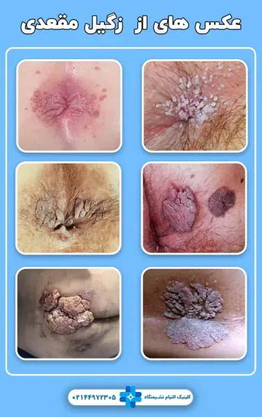  آیا رابطه مقعدی باعث زگیل تناسلی میشود؟