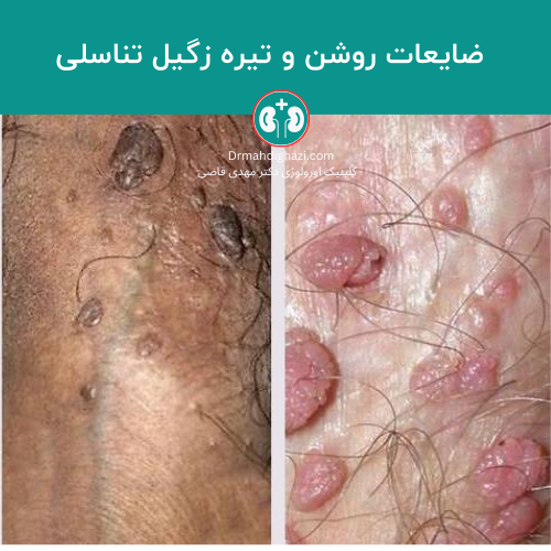  آیا رابطه مقعدی باعث زگیل تناسلی میشود؟