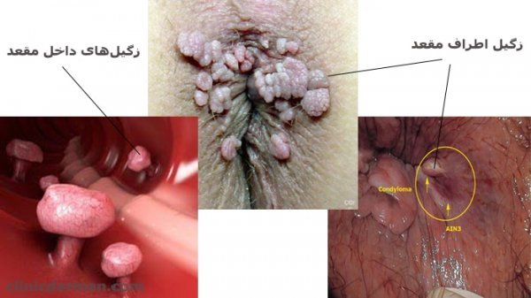  آیا رابطه مقعدی باعث زگیل تناسلی میشود؟