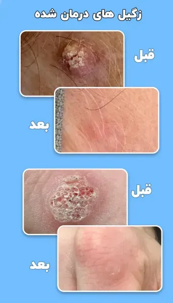  آیا رابطه مقعدی باعث زگیل تناسلی میشود؟