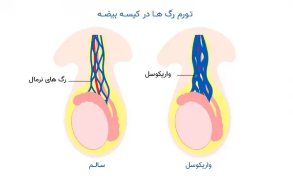  آیا عمل واریکوسل باعث اختلال نعوظ میشود؟
