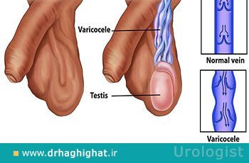  آیا عمل واریکوسل باعث اختلال نعوظ میشود؟