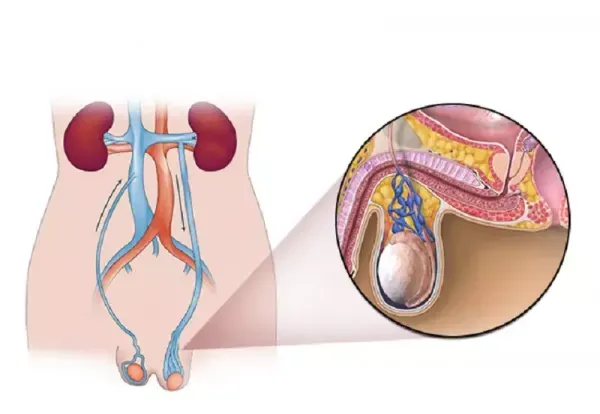  آیا عمل واریکوسل باعث اختلال نعوظ میشود؟