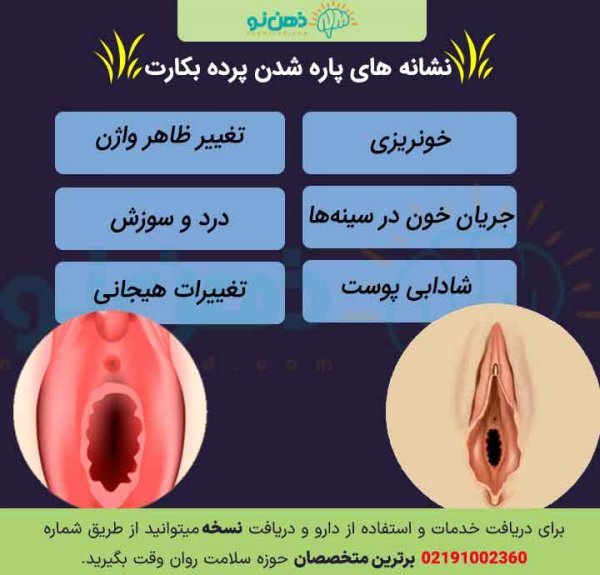 پرده حلقوی خونریزی دارد+پرده حلقوی و سکس