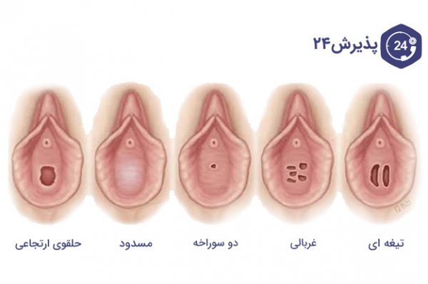  پرده حلقوی خونریزی دارد+پرده حلقوی و سکس
