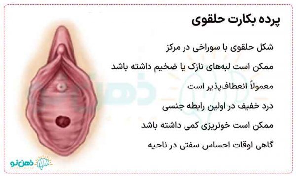  پرده حلقوی خونریزی دارد+پرده حلقوی و سکس