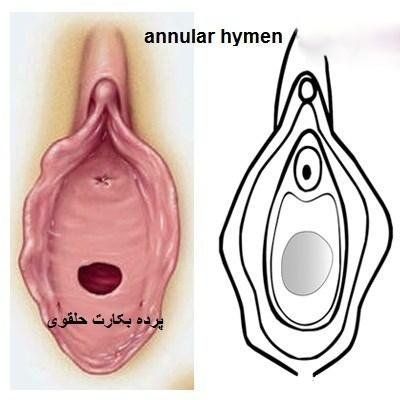  پرده حلقوی خونریزی دارد+پرده حلقوی و سکس