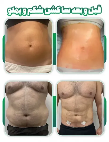هزینه ساکشن /لیپوساکشن شکم و پهلو در تهران