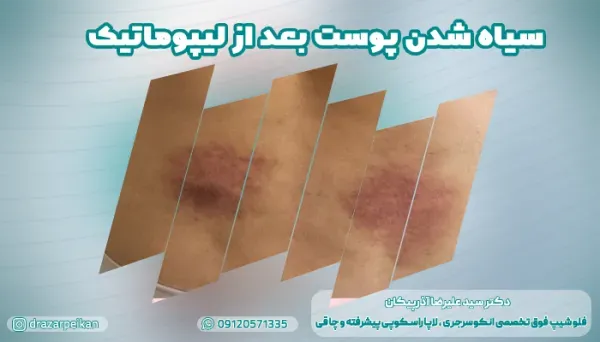  هزینه ساکشن /لیپوساکشن شکم و پهلو در تهران