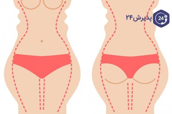  هزینه ساکشن /لیپوساکشن شکم و پهلو در تهران
