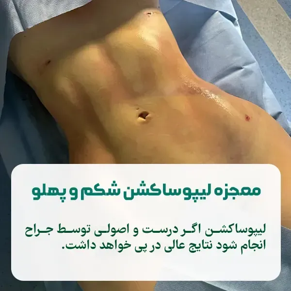  هزینه ساکشن /لیپوساکشن شکم و پهلو در تهران