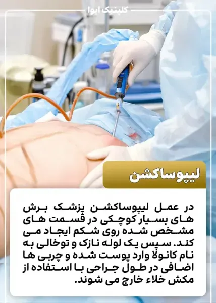  هزینه ساکشن /لیپوساکشن شکم و پهلو در تهران