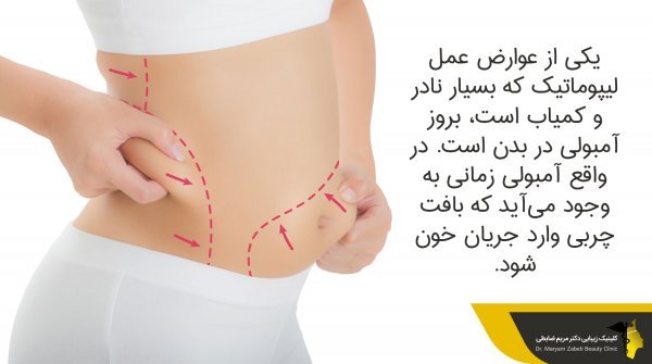  هزینه ساکشن /لیپوساکشن شکم و پهلو در تهران