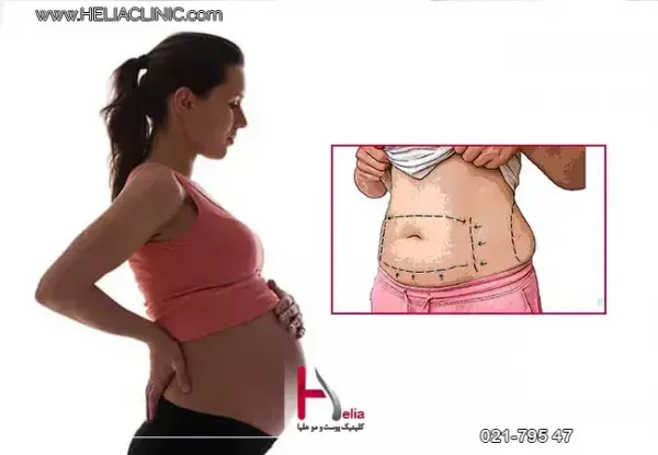  سکس /نزدیکی بعد از لیپوماتیک