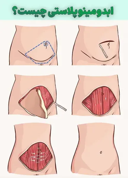  سکس /رابطه زناشویی بعد از ابدومینوپلاستی