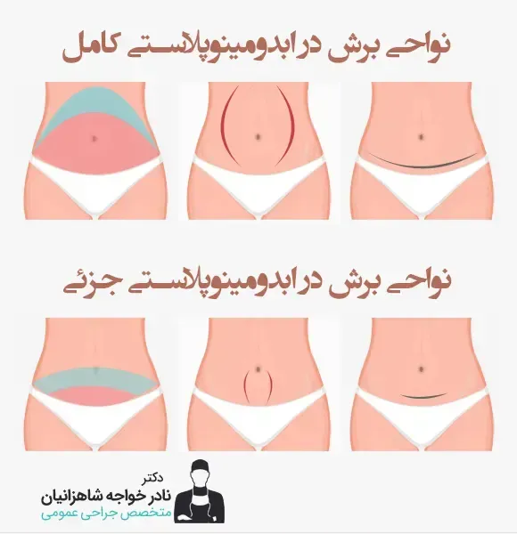  سکس /رابطه زناشویی بعد از ابدومینوپلاستی