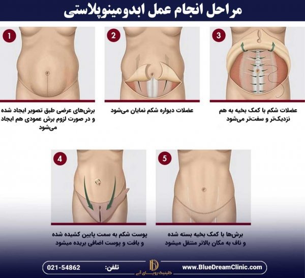  سکس /رابطه زناشویی بعد از ابدومینوپلاستی