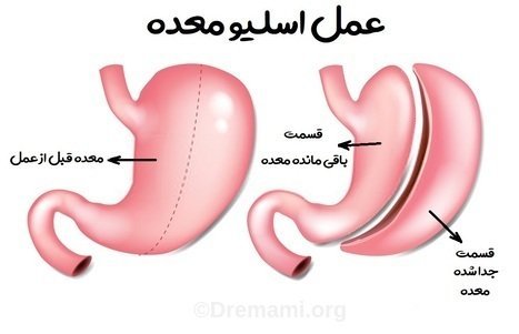 سکس/ رابطه جنسی بعد از اسلیو معده