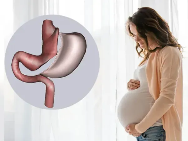  سکس/ رابطه جنسی بعد از اسلیو معده