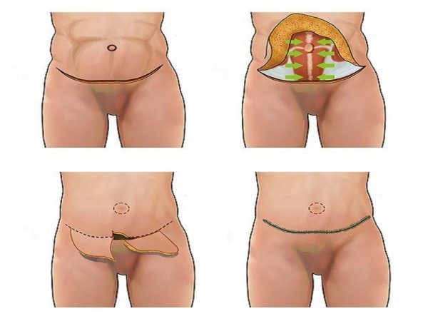 تجربیات عمل ابدو / ابدومینوپلاستی