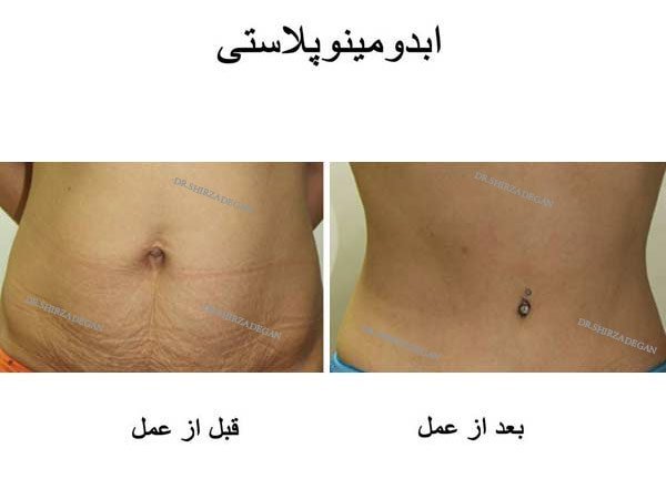  تجربیات عمل ابدو / ابدومینوپلاستی