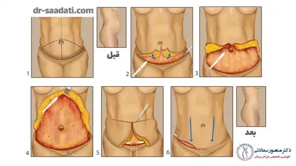  تجربیات عمل ابدو / ابدومینوپلاستی