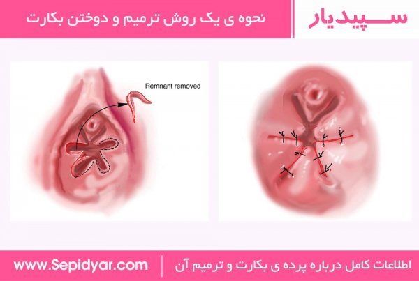  آيا ژیمناستیک باعث پارگي بكارت ميشود؟
