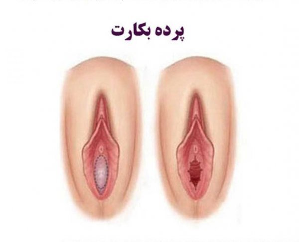  آيا ژیمناستیک باعث پارگي بكارت ميشود؟