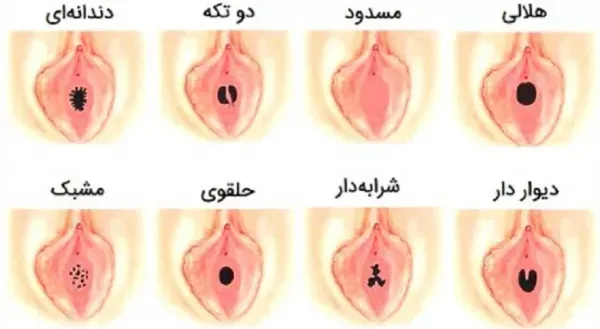  آيا ژیمناستیک باعث پارگي بكارت ميشود؟