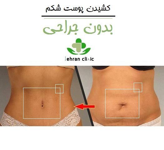 عکس لیفت شکم بدون جراحی