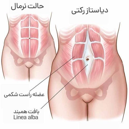  عکس لیفت شکم بدون جراحی