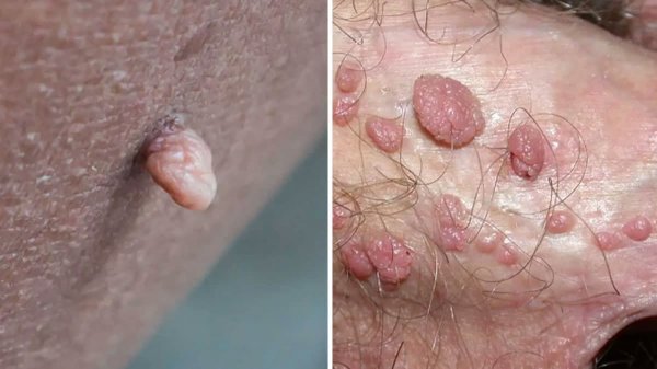  تجربه من از درمان زگیل تناسلی